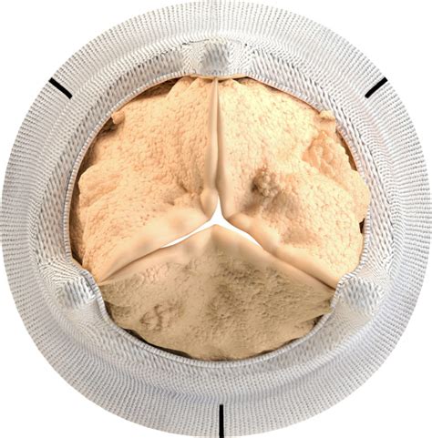 Aortic Bioprosthetic Valve Topview Calcification Heart Valve Choice