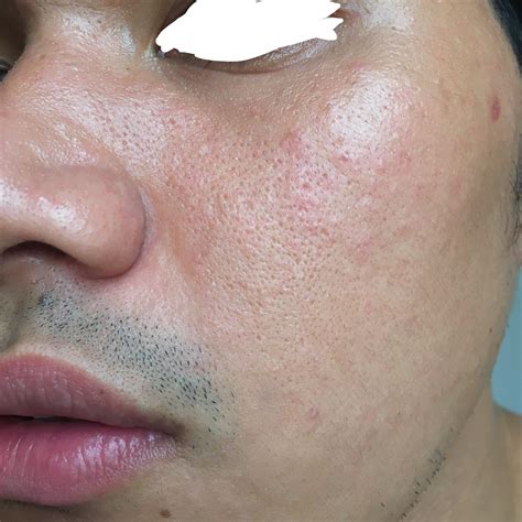 [Routine Help] Dry skin with Fungal Acne. Badly need help for ...