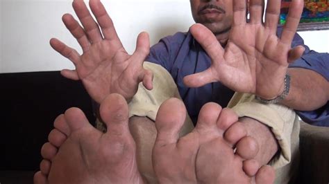 This Man Holds The World Record For Most Fingers And Toes On A Living Person