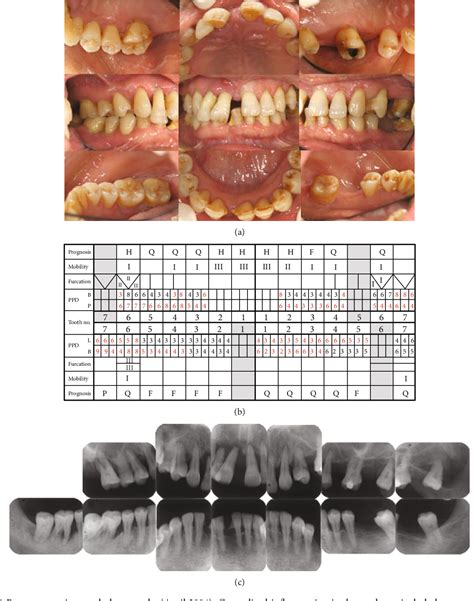 Figure 1 From Implant Treatment With 12 Year Follow Up In A Patient