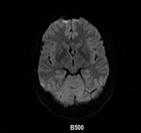 Diffusion Weighteddwi Brain Mri Axial Image