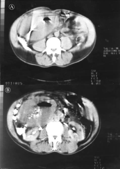 Aspecto Tomográfico Do Tumor À Nota Se Fragmento Metálico No Interior