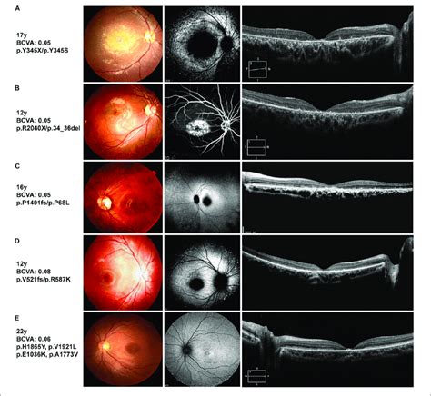 Representative Clinical Features Of Stgd1 Patients Left Color