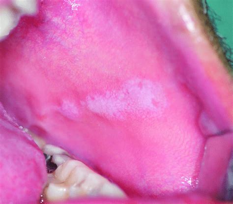 Ol Lesion Of The Left Buccal Mucosa And An Amalgam Restoration In The