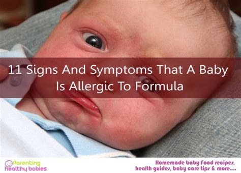 11 Signs And Symptoms That A Baby Is Allergic To Formula