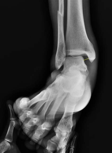 Emrad Radiologic Approach To The Traumatic Ankle