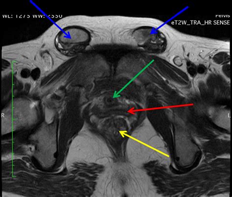 Testicular Feminisation Syndrome Tfs Pacs