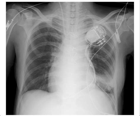 The Postoperative Chest X Ray After The Extubation Showing The