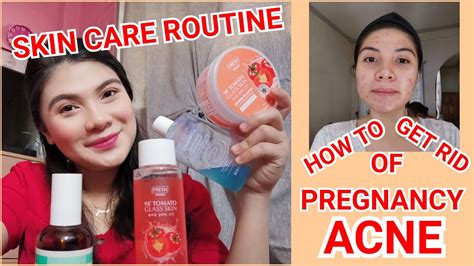 Pregnancy Skincare Routine How To Get Rid Of Pregnancy Acne Youtube