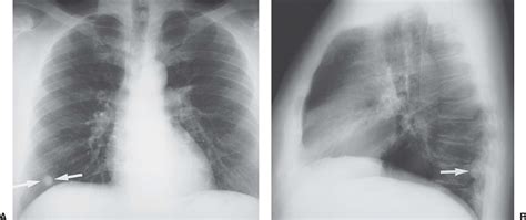 Pulmonary Nodules And Masses Chest X Ray Medschool Vrogue Co