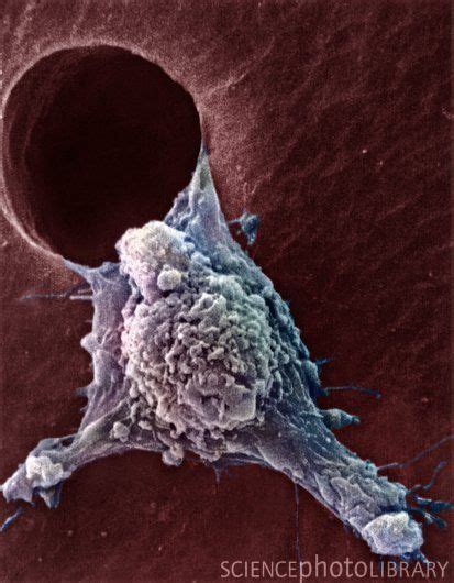 Migrating Cancer Cell Coloured Scanning Electron Micrograph Sem Of A