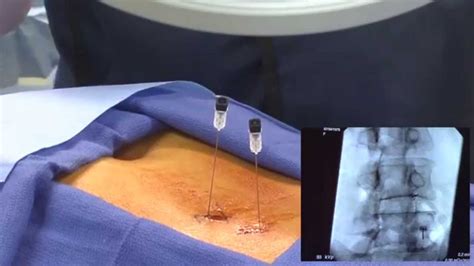 Watch An Epidural Steroid Injection Demonstration Live Youtube