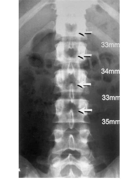 A Normal Ap Radiograph Of Lumbar Spine Showing The Relation Between The