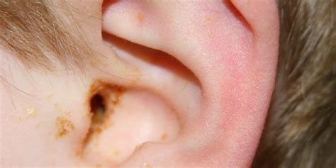 Ear Infection Middle Ear Causes Symptoms Diagnosis And Treatment