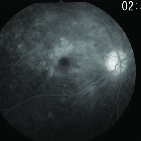 Fundus Photograph Of The Right Eye Revealed Diffuse Vitreous Opacity