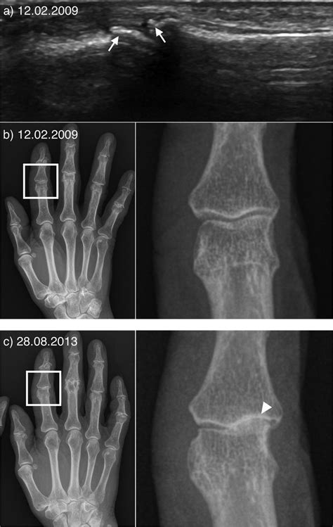 Ultrasound Detected Osteophytes Predict The Development Of Radiographic
