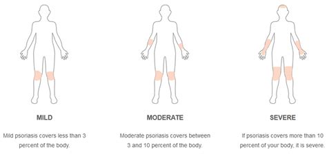 Plaque Psoriasis Causes And Treatment Of Moderate To Severe