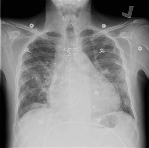 Tricuspid Valve Replacement Radiology Case