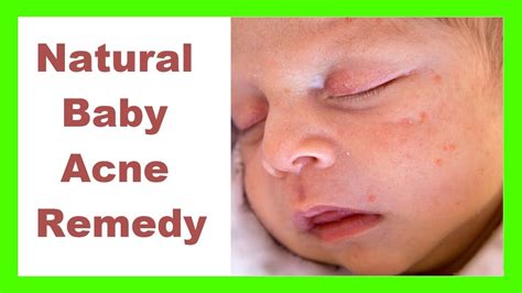 Baby Acne Remedy Natural Baby Acne Remedy Citations Santé Santé