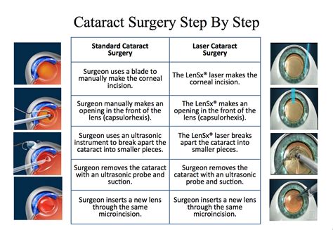 An ophthalmologist has the knowledge and training to diagnose a cataract, help you make a decision regarding the need. cataract surgery process - Gailey Eye Clinic
