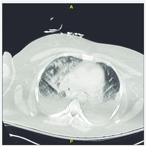 Computed Tomography Of The Chest Reveals Bilateral Pleural Effusions