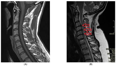 How To Read An Mri Of The Cervical Spine