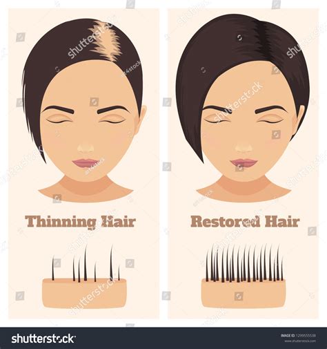 Woman Thinning Restored Hair Female Pattern Stock Vector Royalty Free