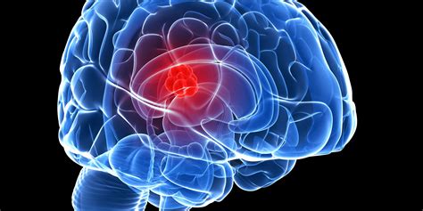 Learn About Brain Tumors Preston A Wells Jr Centerfor Brain Tumor