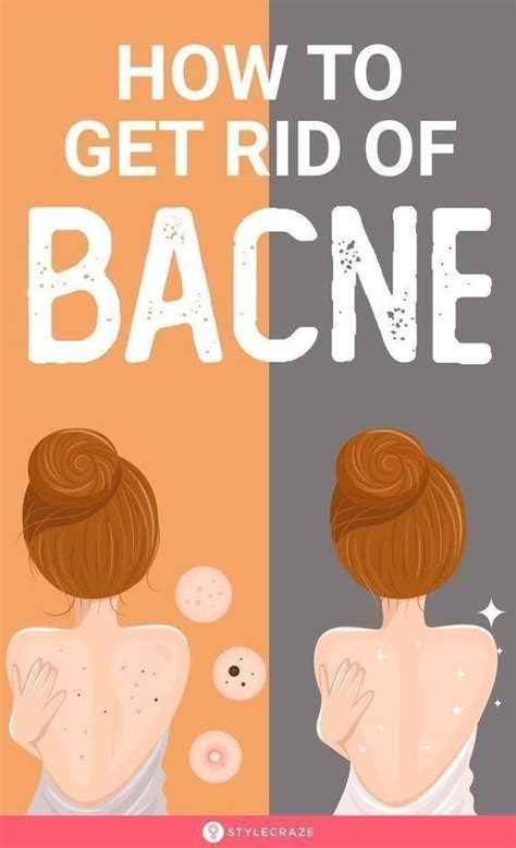 How To Get Rid Of Bacne For Good Artofit