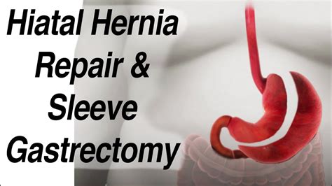 Hiatal Hernia Repair And Sleeve Gastrectomy Weight Loss Surgery Animation