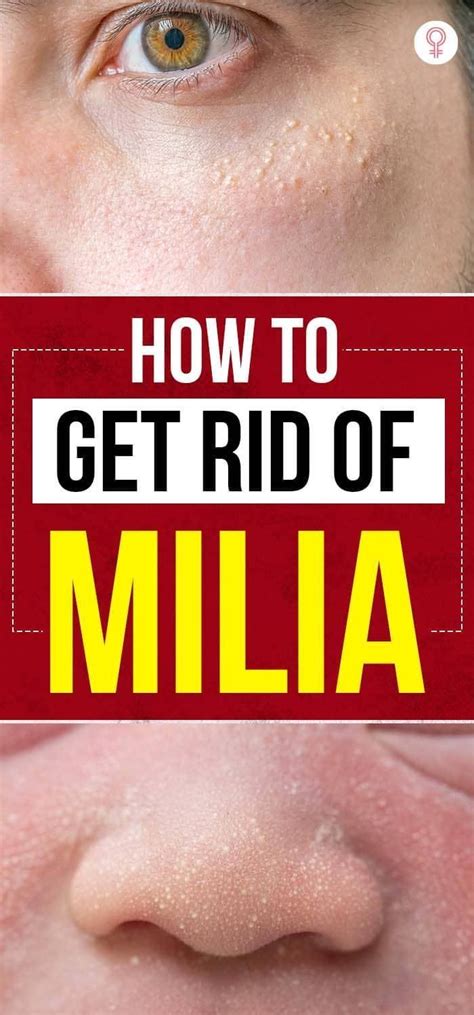 How To Get Rid Of Milia At Home Prevention Tips Artofit