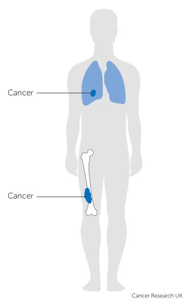 The Stages Of Bone Cancer Cancer Research Uk