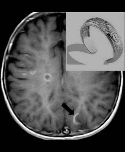 Post Contrast T1 Weighted Mr Image Showing An Incomplete Ring Lesion