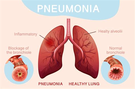 Poster For Pneumonia With Human Lungs 1109633 Vector Art At Vecteezy