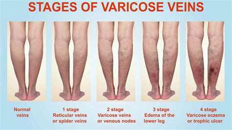 Stages Of Varicose Veins Youtube