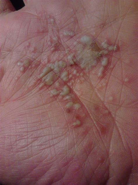 I Have Crohns And I Usually Get Blisters On My Hands Every