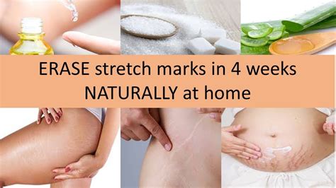 How To Remove Stretch Marks Naturally At Home Get Rid Of Stretch Marks