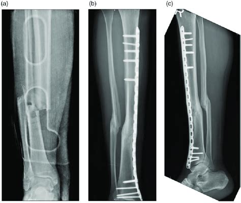 Representative X Rays Of A Patient In The Middle 13 Tibial Shaft