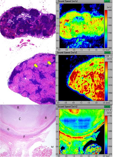 Aupper An Elliptical Lymph Node With Sarcoidal Granulomas The