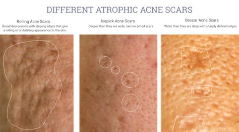 Acne Scar Treatment Needles Lasers And Radio Frequency Jivakacare