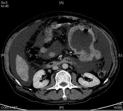 The Ct Scan Of The Abdomen Showed A Thick Walled Lesion Filled With