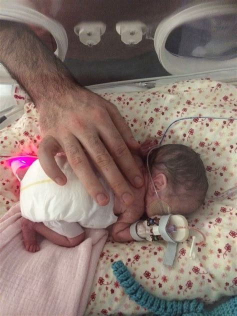 Baby Girl Born So Premature Her Eyes Were Still Fused Shut And Her Skin Was See Through Returns