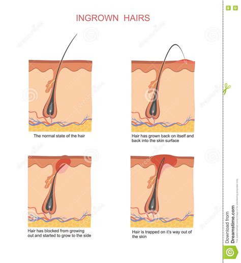 Attacking it with your tweezers is likely to create or worsen an infection. Ingrown hairs stock vector. Illustration of medicine ...