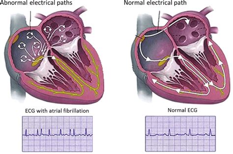 atrial fibrillation ekg vs normal