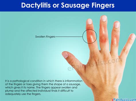 Dactylitis Or Sausage Fingerstreatmenttypescausessymptoms