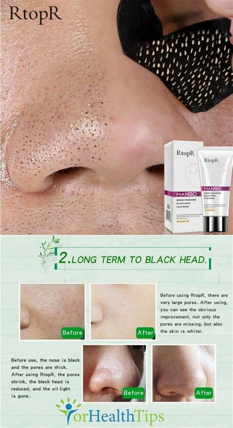 How To Remove Blackheads And Whiteheads Permanently Howtormeov