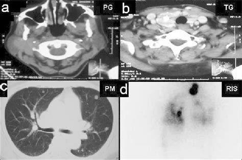 A Ct Images Showing Hypodense Mass Lesion Involving The Deep Lobe Of