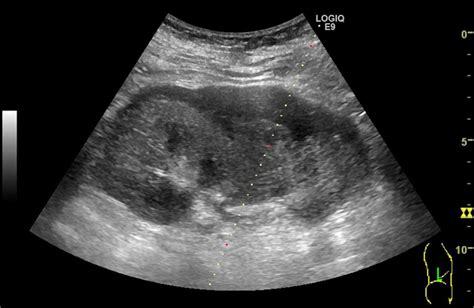 Acute Renal Failure And Arterial Hypertension Due To Subcapsular