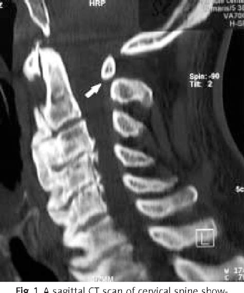 Figure 1 From An Unusual Case Of High Cervical Spinal Cord Injury