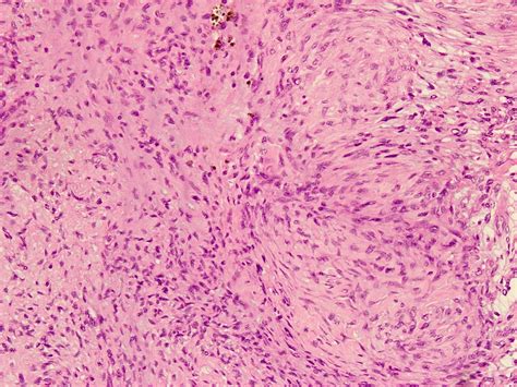 Pathology Outlines Angiomatoid Fibrous Histiocytoma